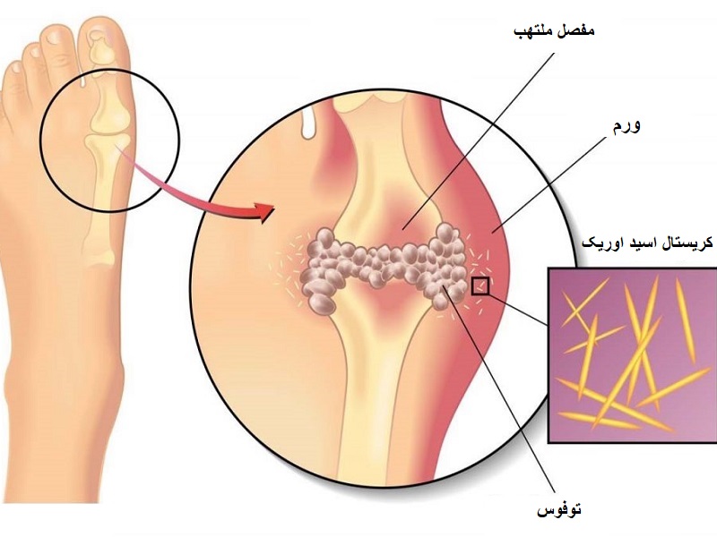 بیماری نقرس