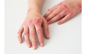 موارد ابتلا به «پسوریازیس» در جهان افزایش یافت