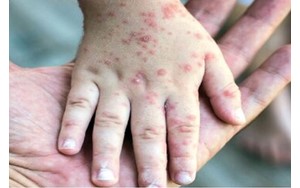 سر و کله ویروس سرخک از کجا پیدا شد؟