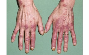 لوپوس در کودکان خطرناک‌تر و پیشرونده‌تر است