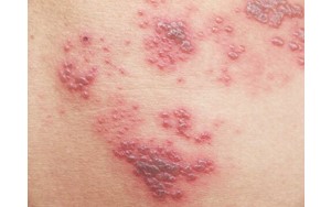 ویژگی‌های خاص واکسن زونا