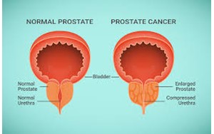 چرا به سرطان پروستات دچار می­شویم؟