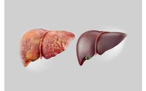 کبد چرب؛ بیماری خاموش قرن کم‌تحرکی