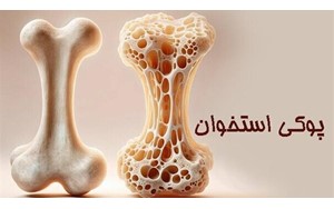بیماری خاموشی که بی‌صدا استخوان‌ها را می شکند