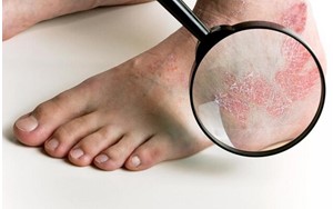 افراد مبتلا به پسوریازیس شدید در معرض خطر بیشتر بیماری قلبی هستند