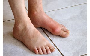 داروهای نقرس به سلامت قلب نیز کمک می‌کنند