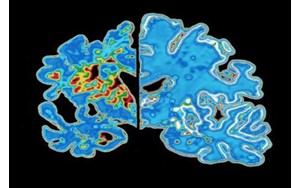 دانشمندان «ساعت آلزایمر» ساختند